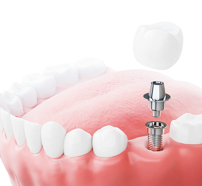 インプラントのイメージ