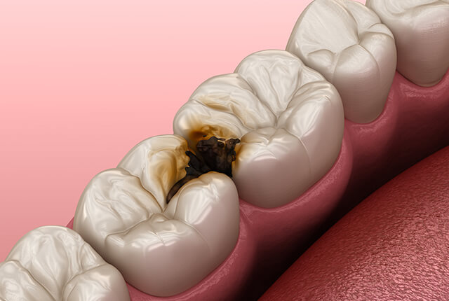 むし歯のイメージのイラスト