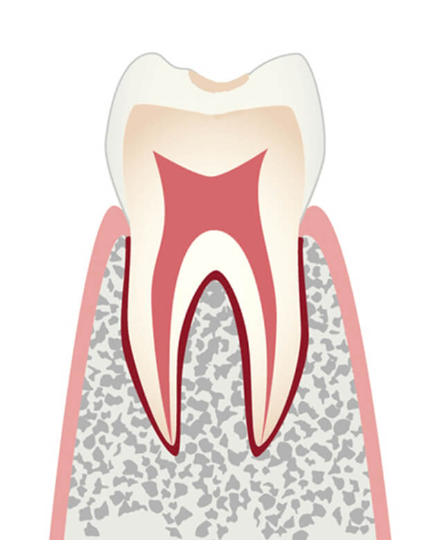 初期のむし歯