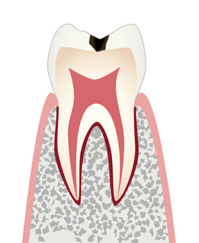 エナメル質に小さな穴が開いたむし歯