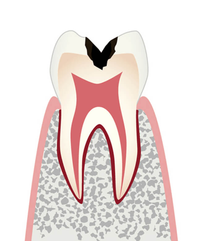 歯の内部まで進行したむし歯