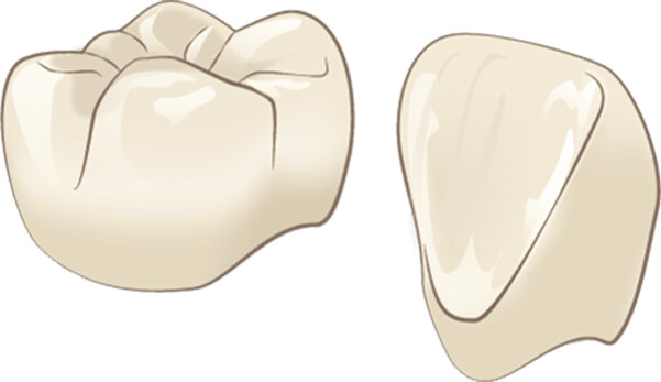 硬質レジンジャケット冠