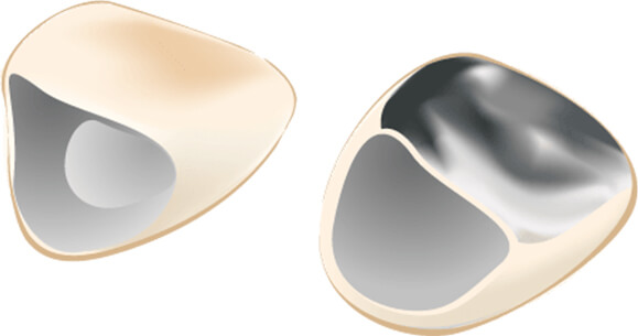 硬質レジン前装冠