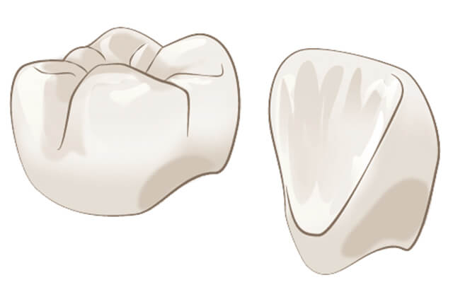 オールセラミック