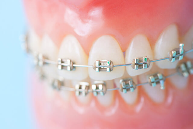 矯正装置が装着された模型