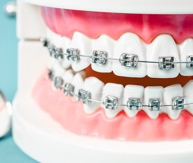 ワイヤー矯正のイメージ